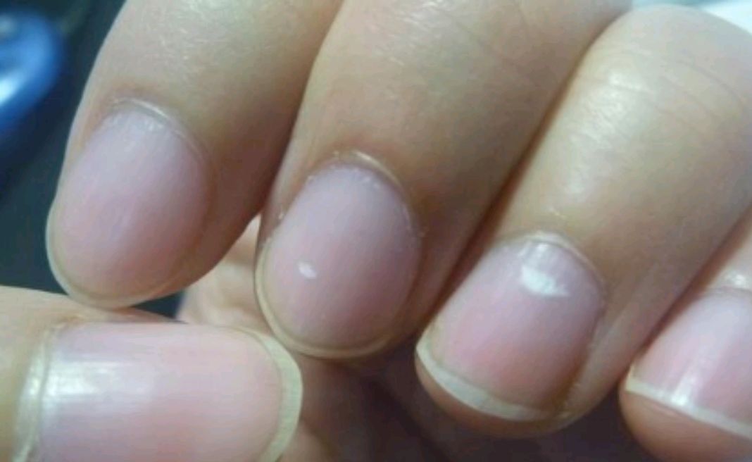女性指甲上有白色斑点图片