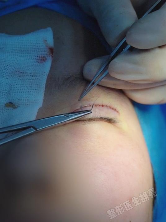 沉浸式体验双眼皮精细缝线过程