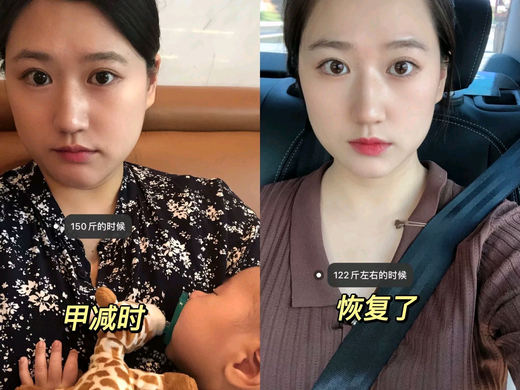 只要得了甲减后,就会导致体重增加,胖个20斤都是很普遍的,但是不要怕