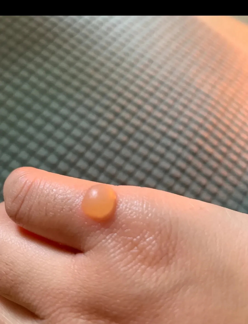 睡了一觉,手上莫名其妙的长了一个大水泡!我到医院挂皮肤科可对?