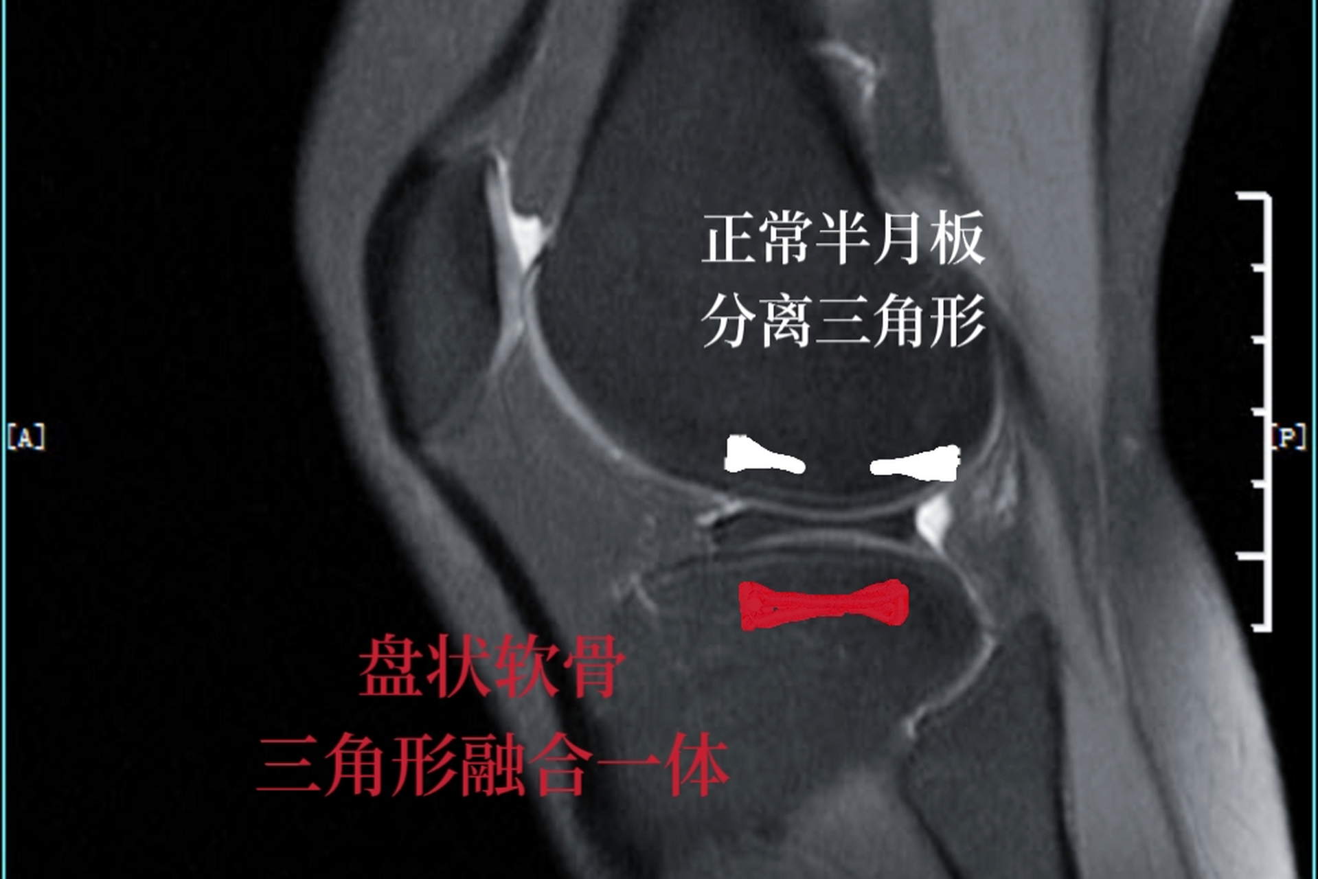 在解剖结构上半月板外缘比较高,内缘相对比较锐利,所以在磁共振影像上