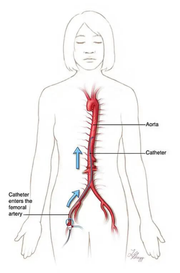 femoral artery图片