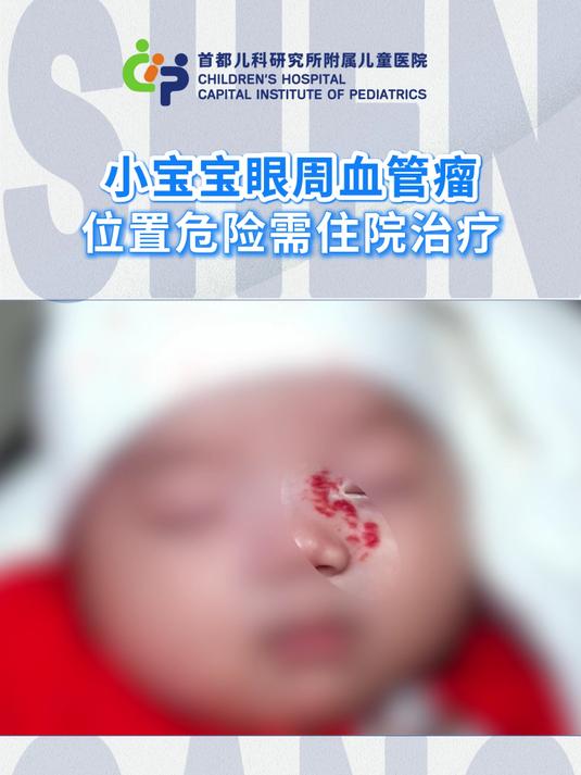 小宝宝眼周血管瘤 位置危险需住院治疗