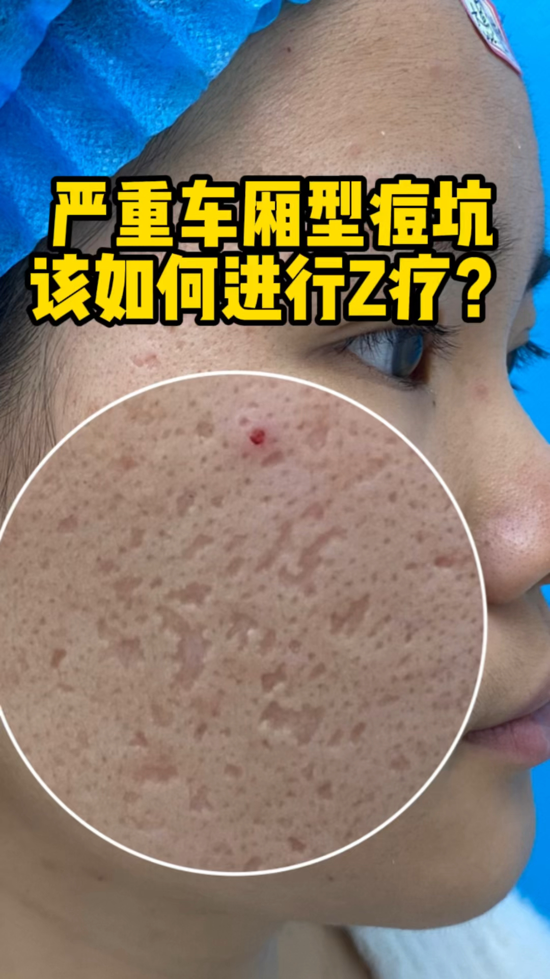 严重车厢型痘坑该如何进行治疗?