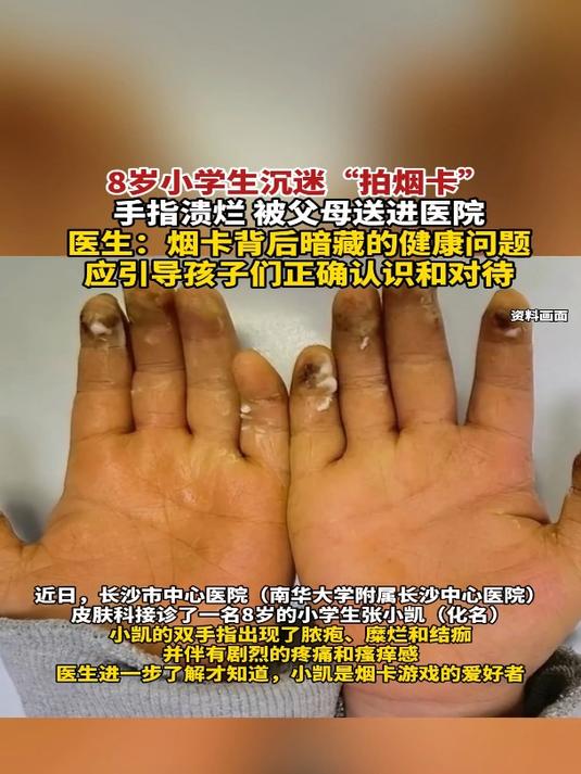 8岁小学生沉迷"拍烟卡"手指溃烂,被父母送进医院