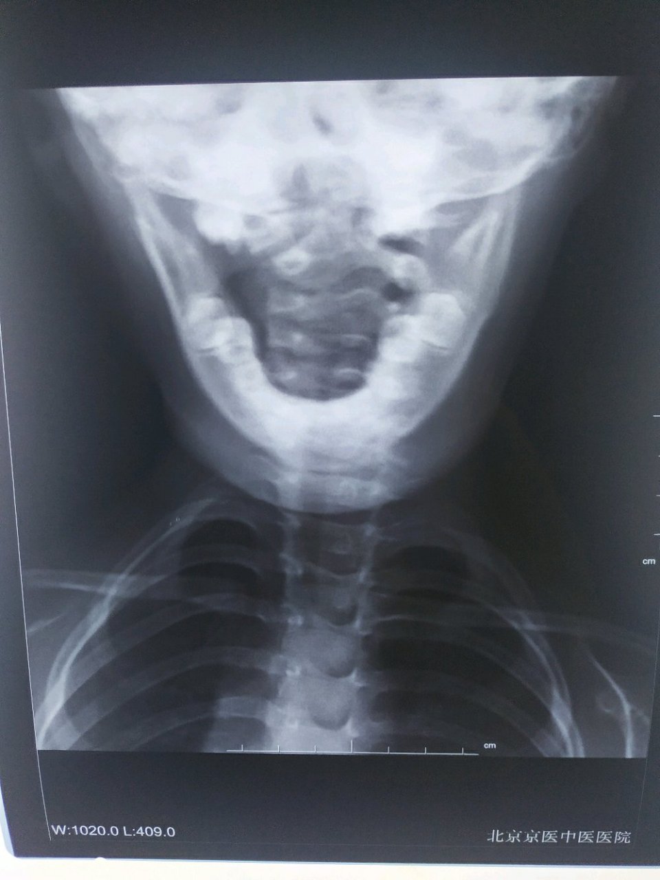 罗氏正骨罗翠花在哪出诊# #罗氏正骨罗翠花正# #罗氏罗有明正骨# 小