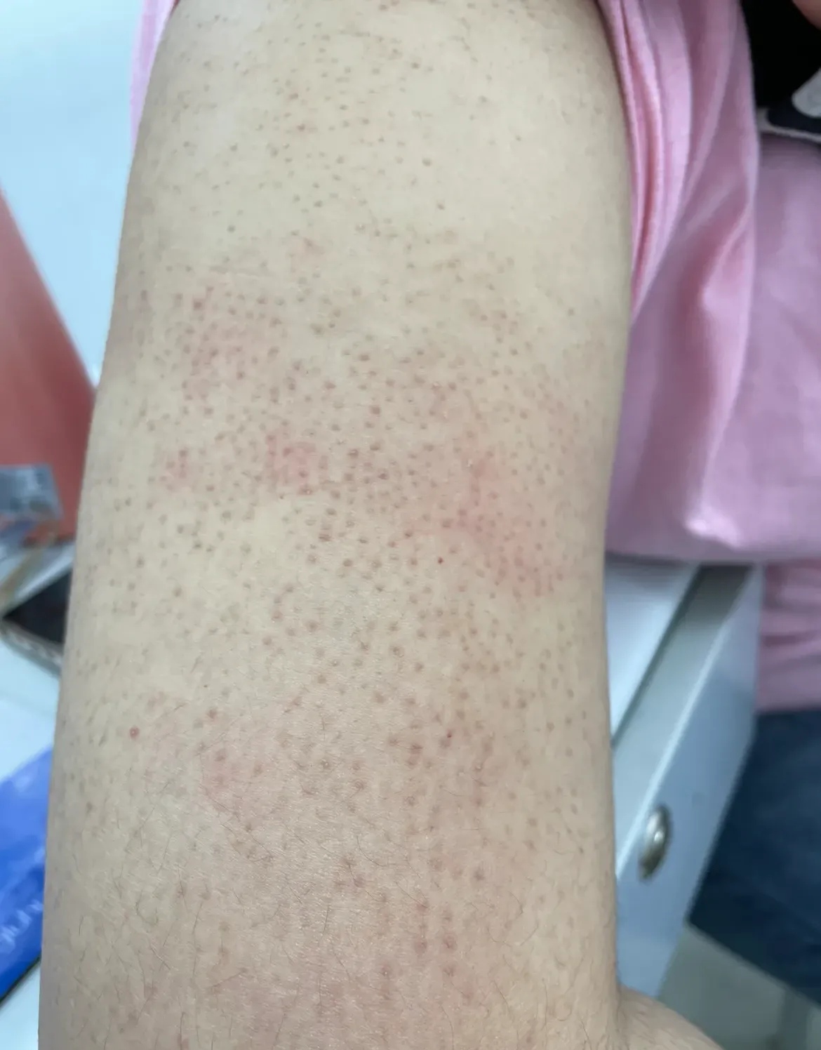 今天教大家如何处理--"鸡皮肤",也就是毛周角化病:  可以每天多次