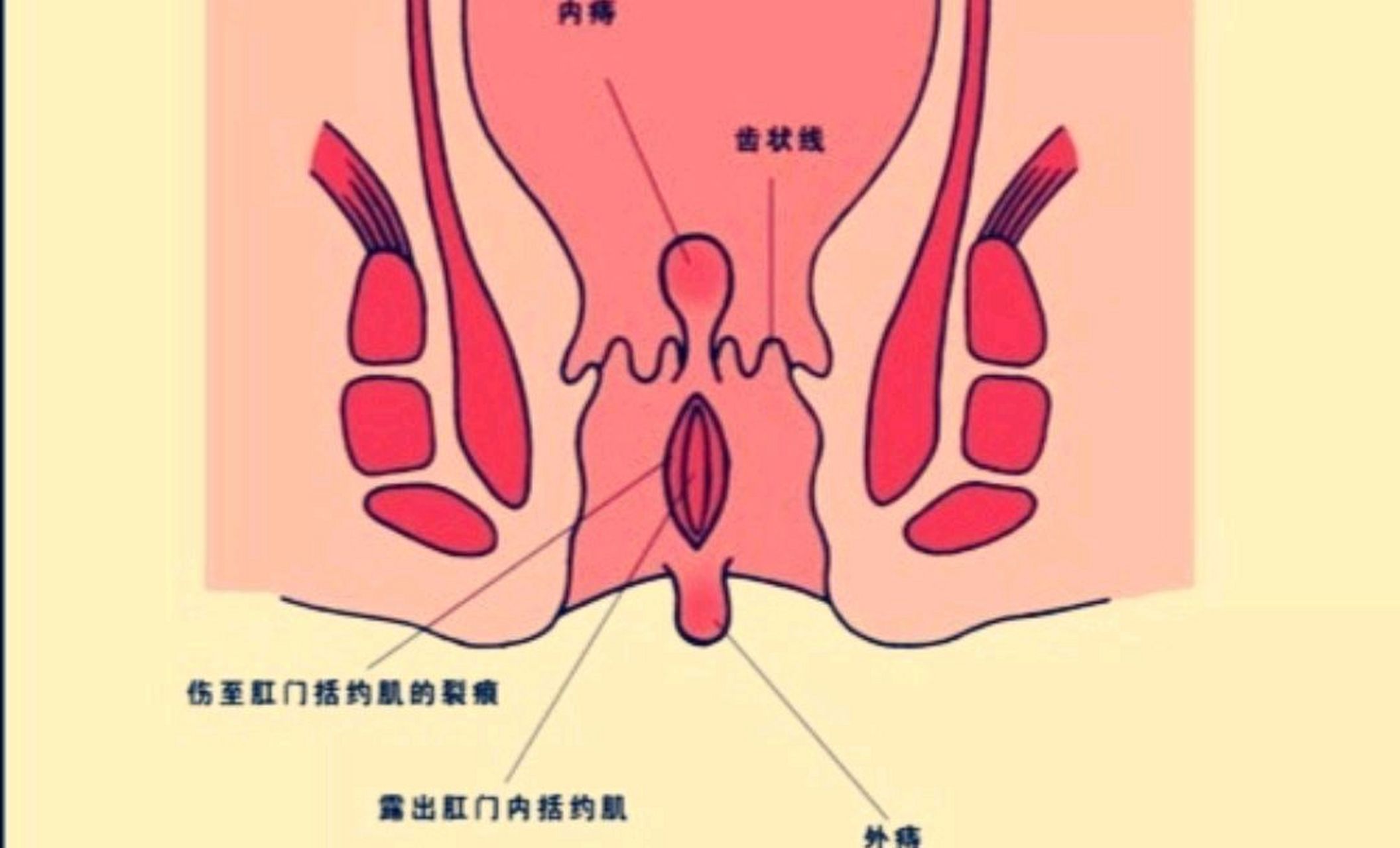 痔疮可以说是临床上最常见的肛门病了,