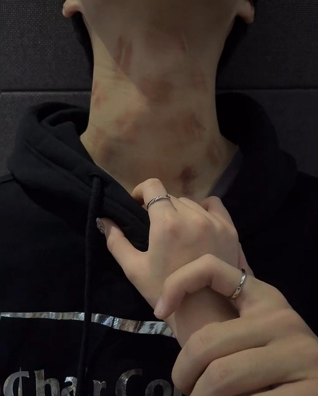 同事的对象有暴力倾向经常见脖子被掐成这样,为什么不分手?