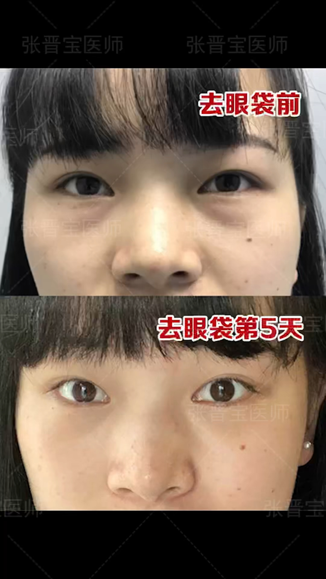 28岁女士微创去眼袋术前术后效果对比,同款眼部情况可参考