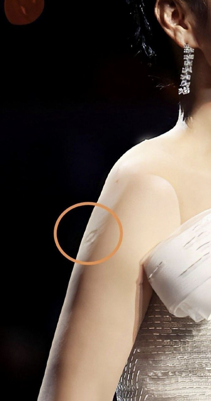 这是卡介苗留的疤吧?但是不知道为啥我没有留下那个疤.