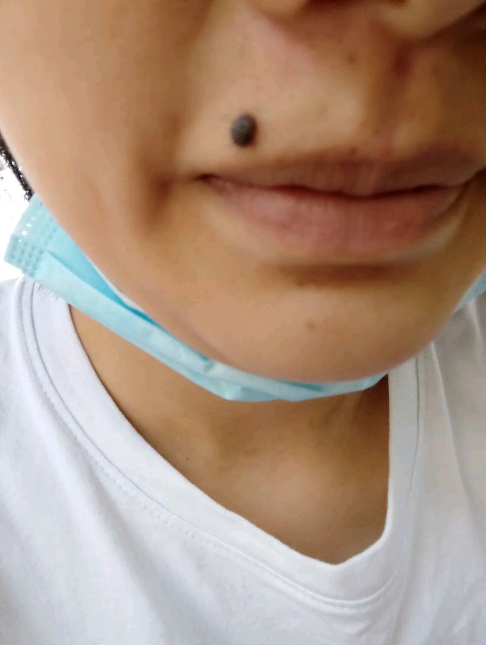 切这一颗痣要花2000块,我今天刚刚去医院看了,小时候就长了,现在越来