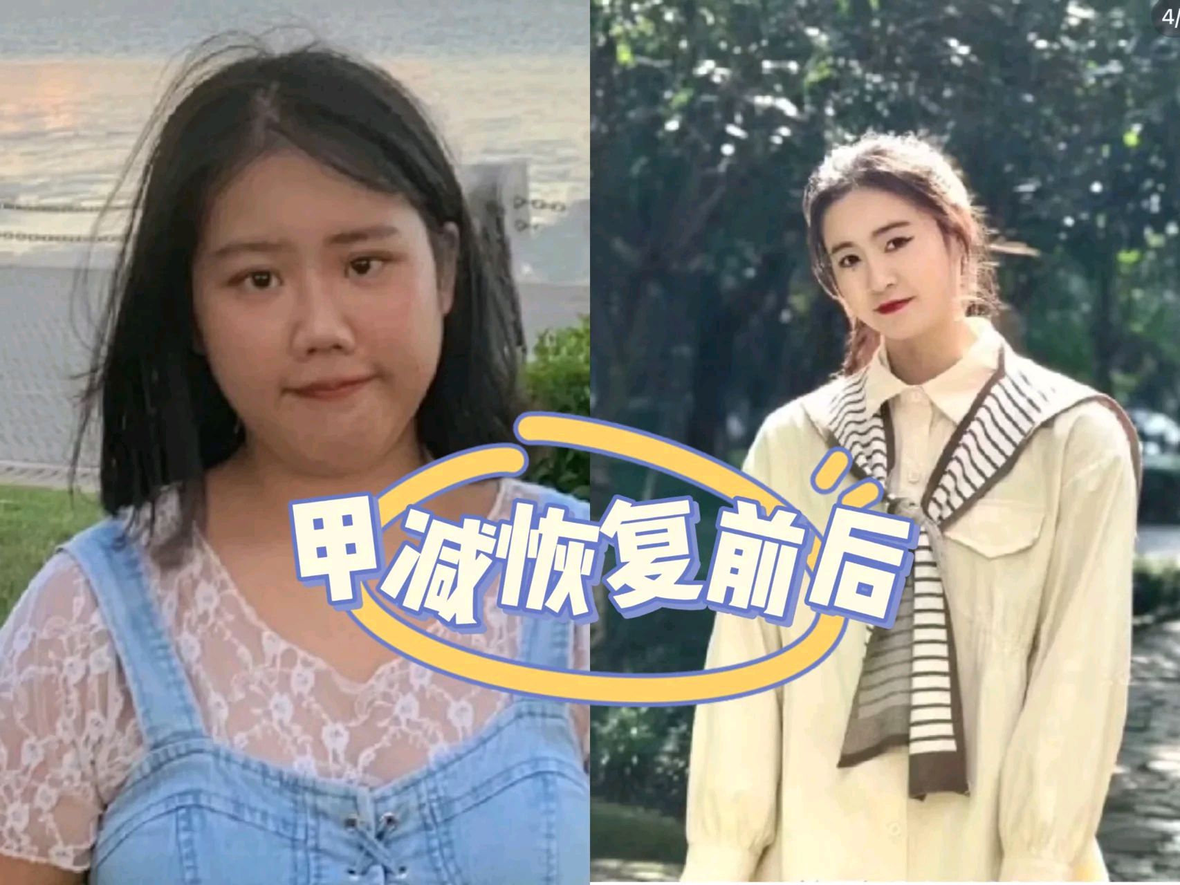 女性甲减面容图片图片