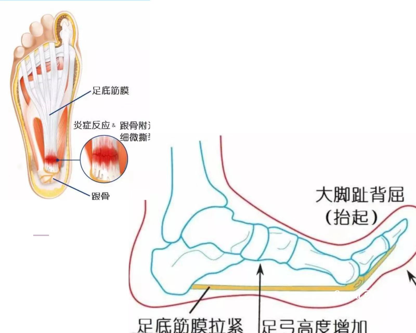 高足弓有哪些危害?