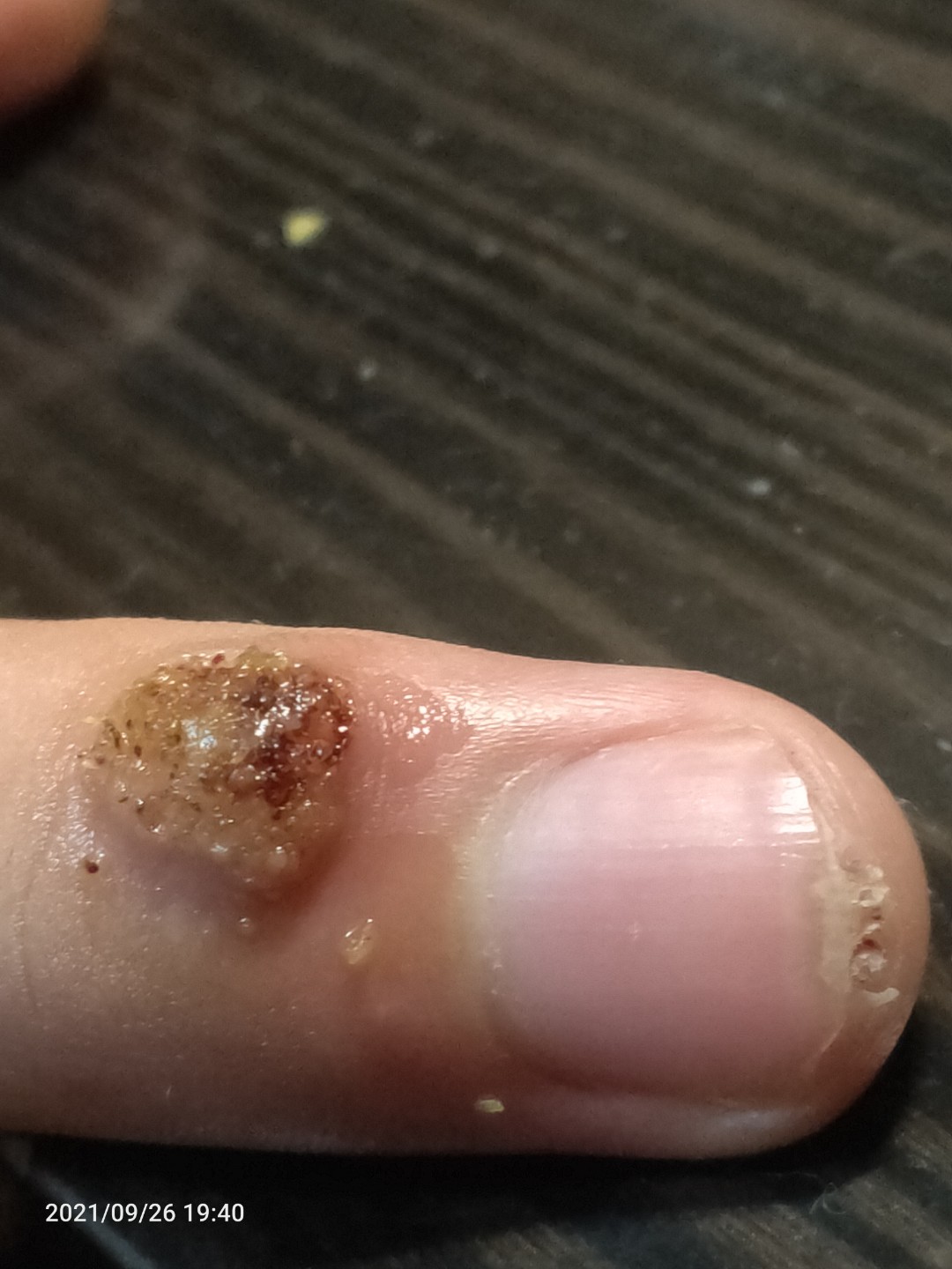 手上脚背不幸感染了hpv病毒的刺疣该怎么办?