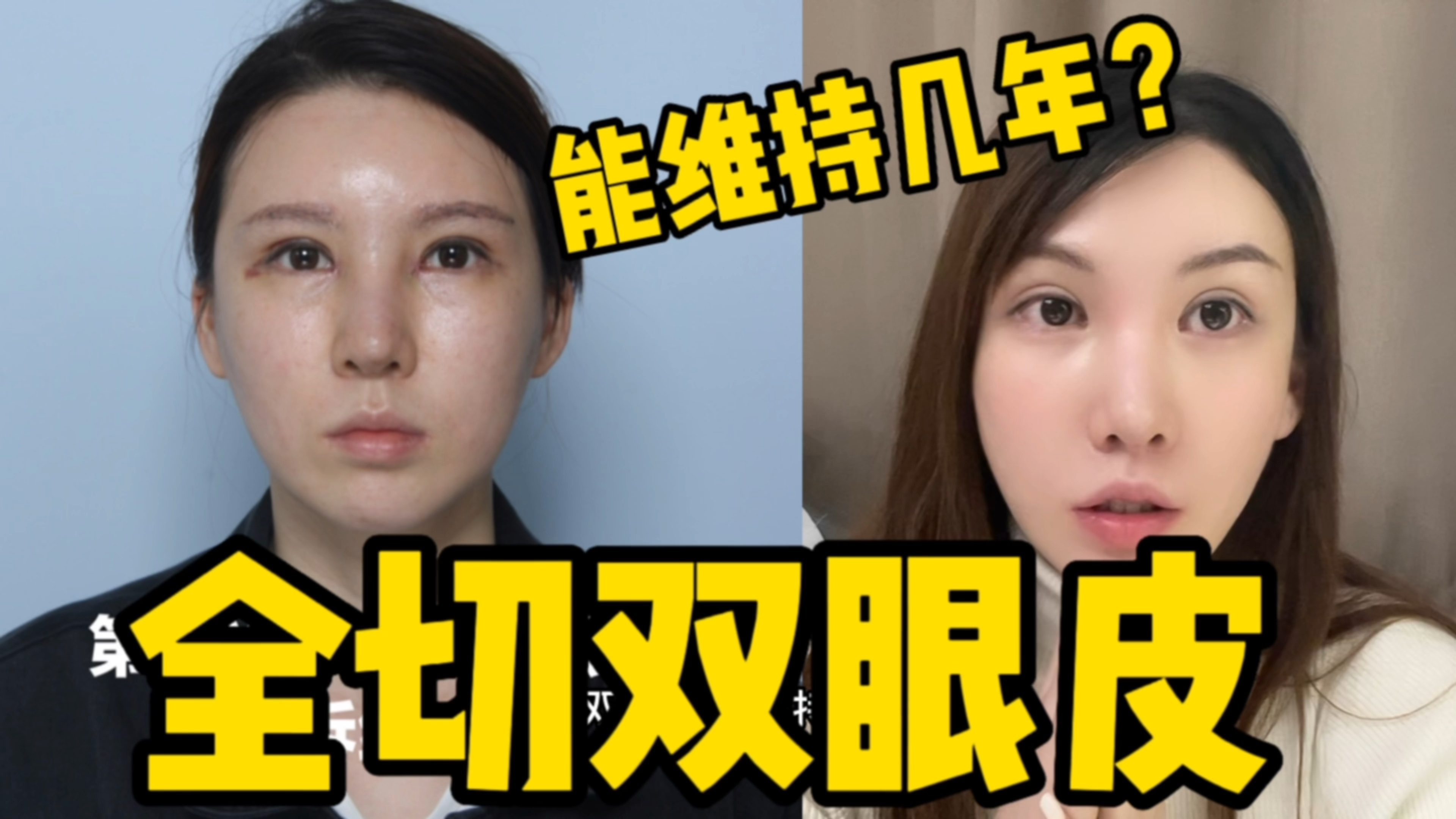 全切双眼皮能维持几年?
