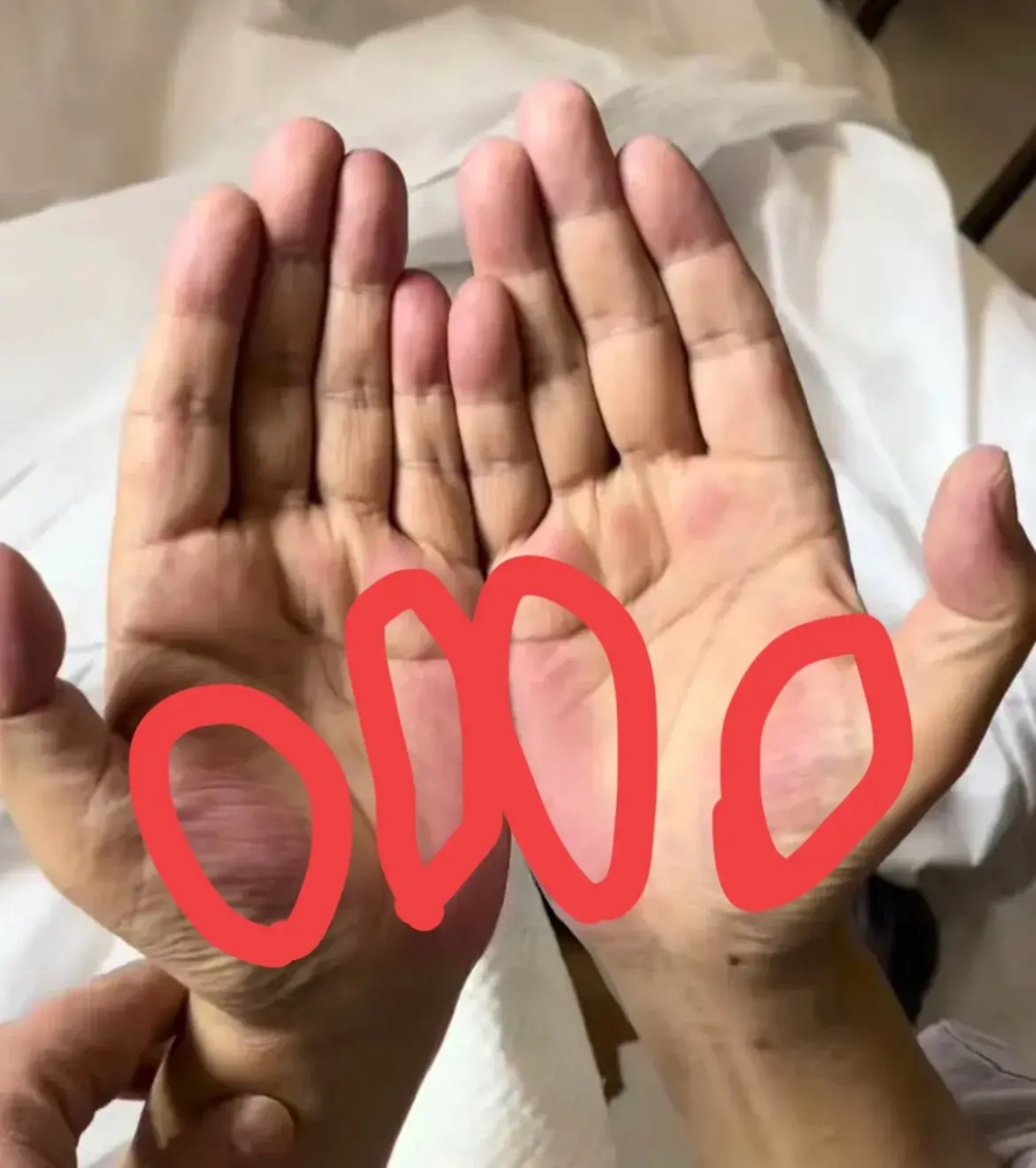 手掌的大,小鱼际红肿?  是身体出了什么毛病吗?