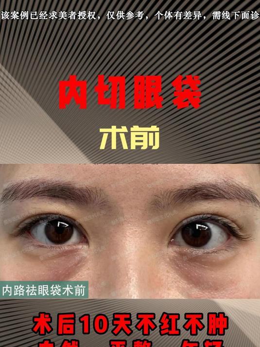 内切眼袋,术后10天不红不肿,自然,平整,年轻,恢复的真快