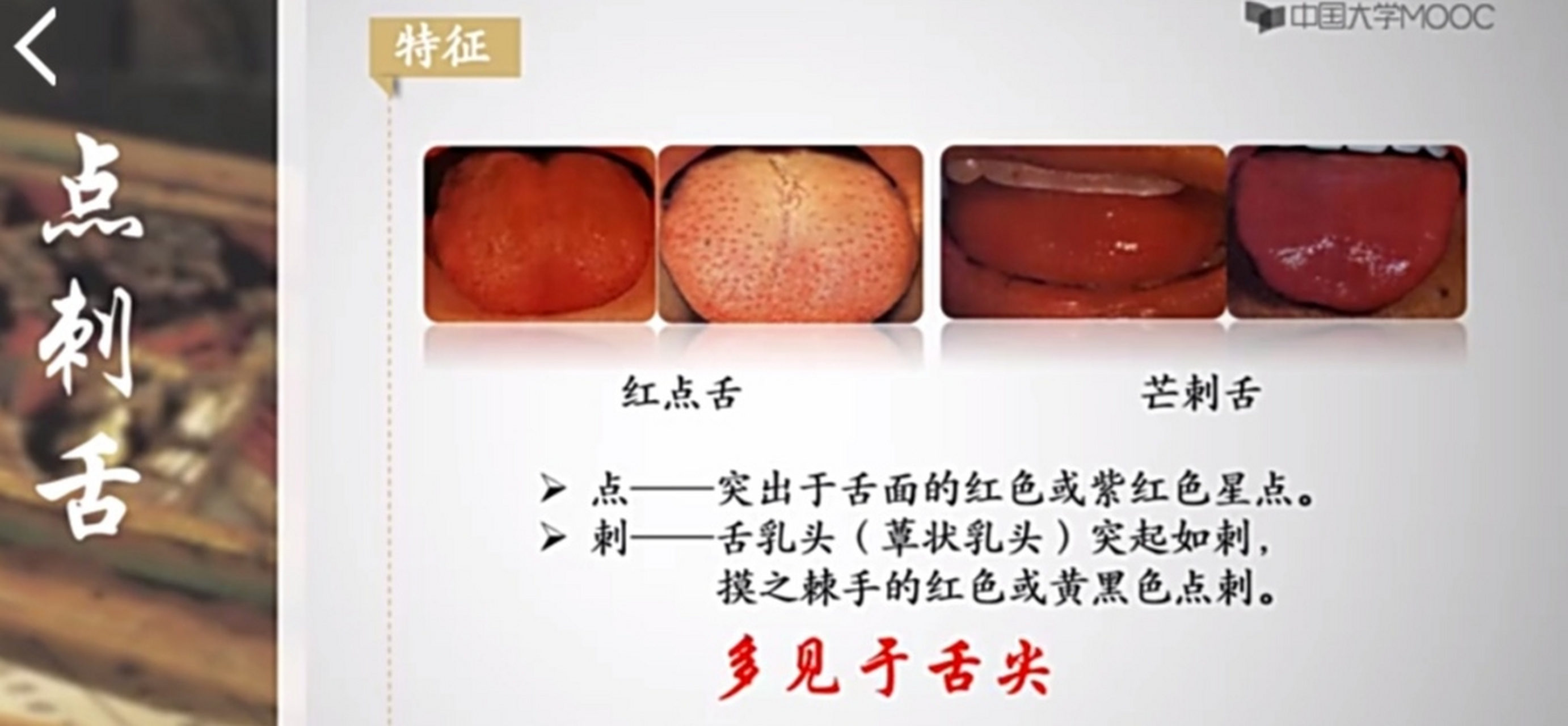 中医"望舌形"一一点刺舌,裂纹舌,齿痕舌的特征和意义