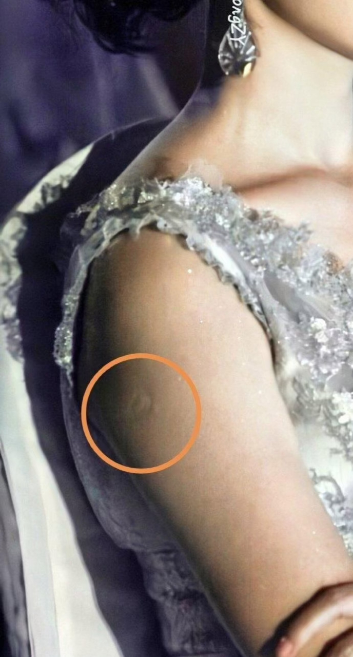 为什么大部分人手臂上都有这个胎记?