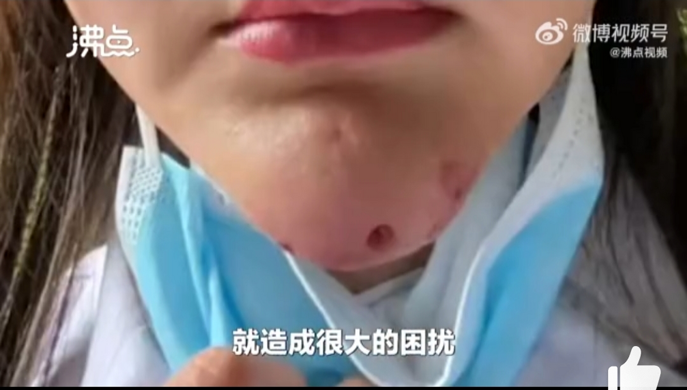 女子注射生长因子7年后下巴疯长破溃# 看着触目惊心[衰][衰][衰]黑