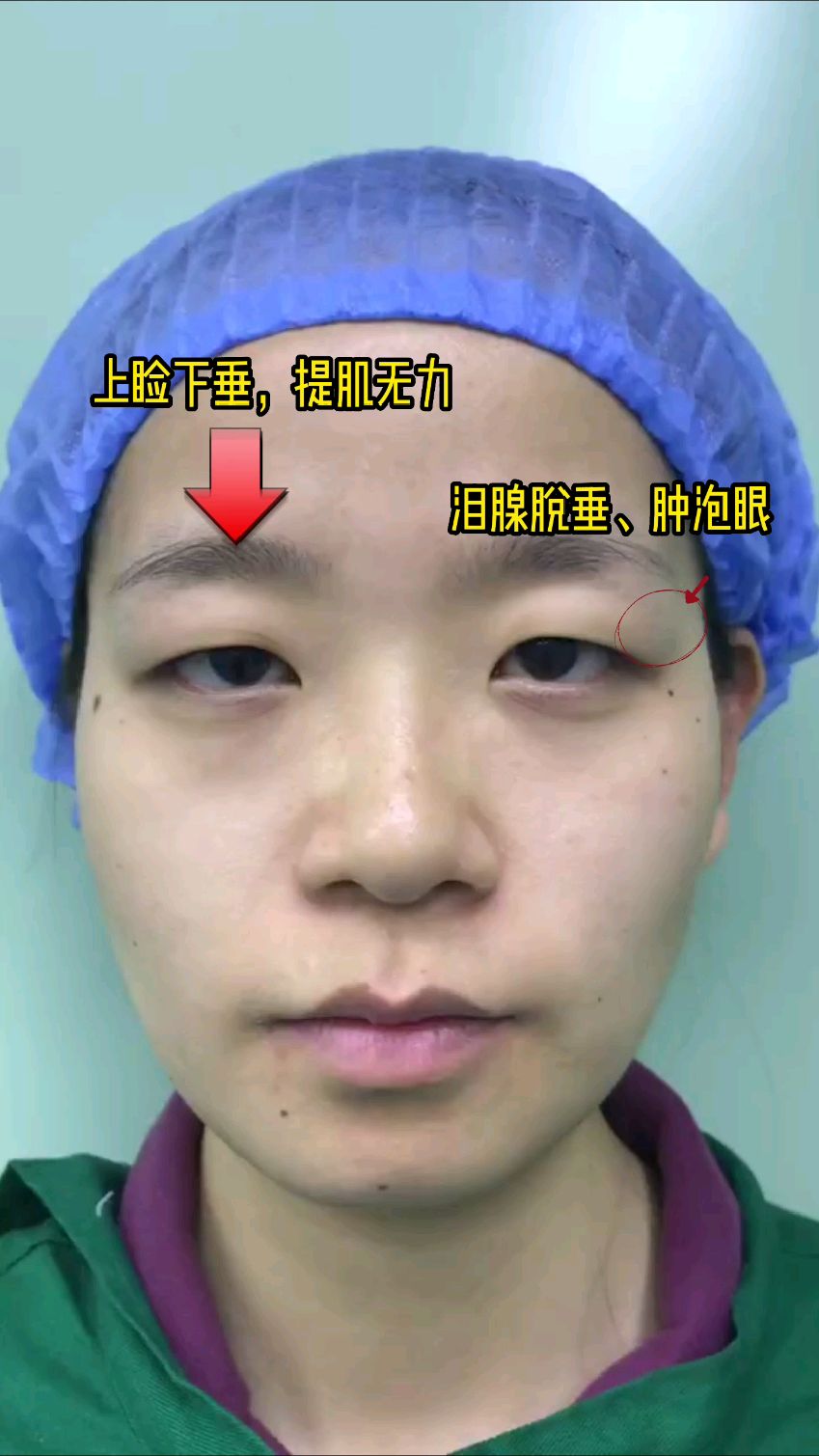 上睑下垂,提肌无力,泪腺脱垂,肿眼泡