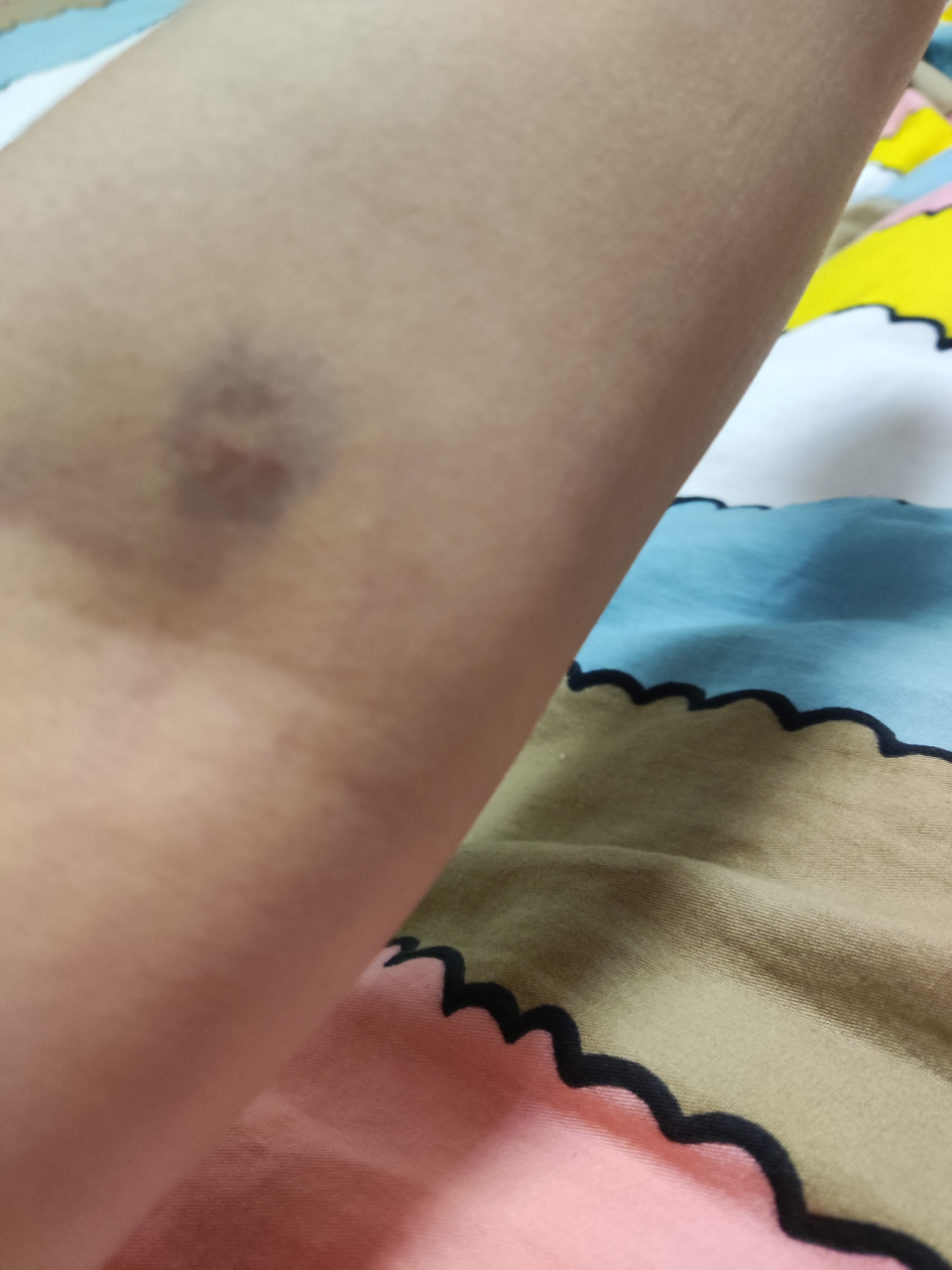 每次抽血都会黑青一片,这次算好的了!#健康