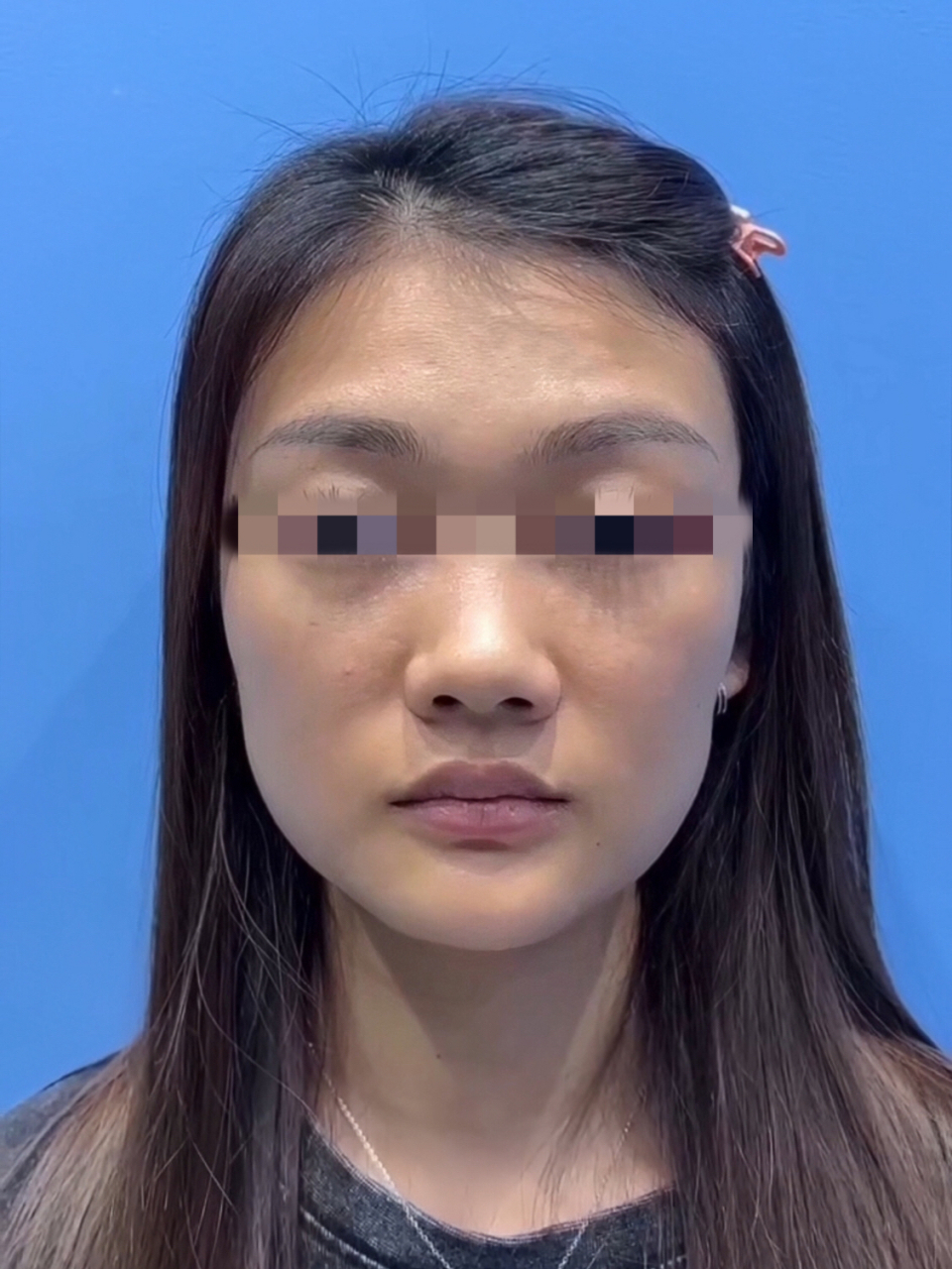 口角囊袋凸出,导致下颌缘不清晰下垂  方案97苹果肌复位77印第安