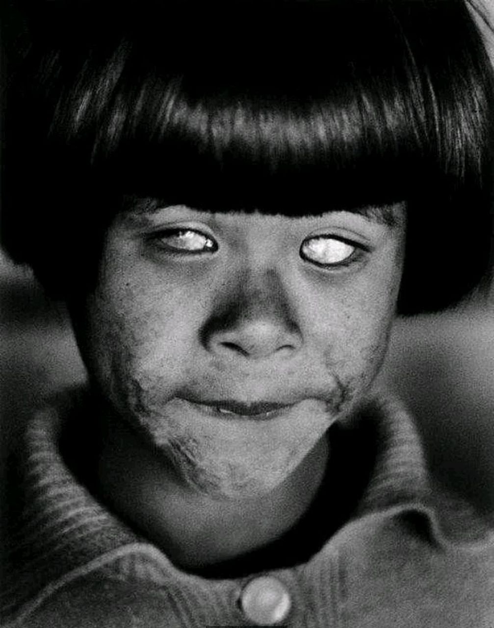 这是1945年,一名在广岛原子弹爆炸后,幸存的小女孩.