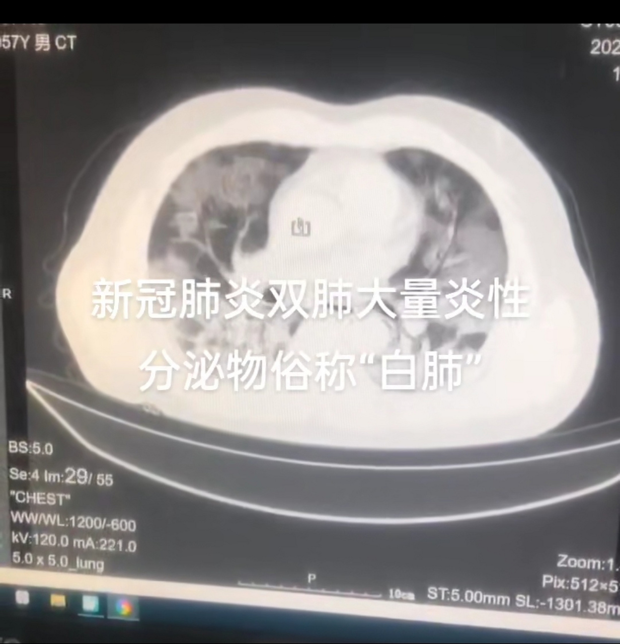 白肺能治好嗎# 不太明白,保護好自己希望疫情早點結束吧