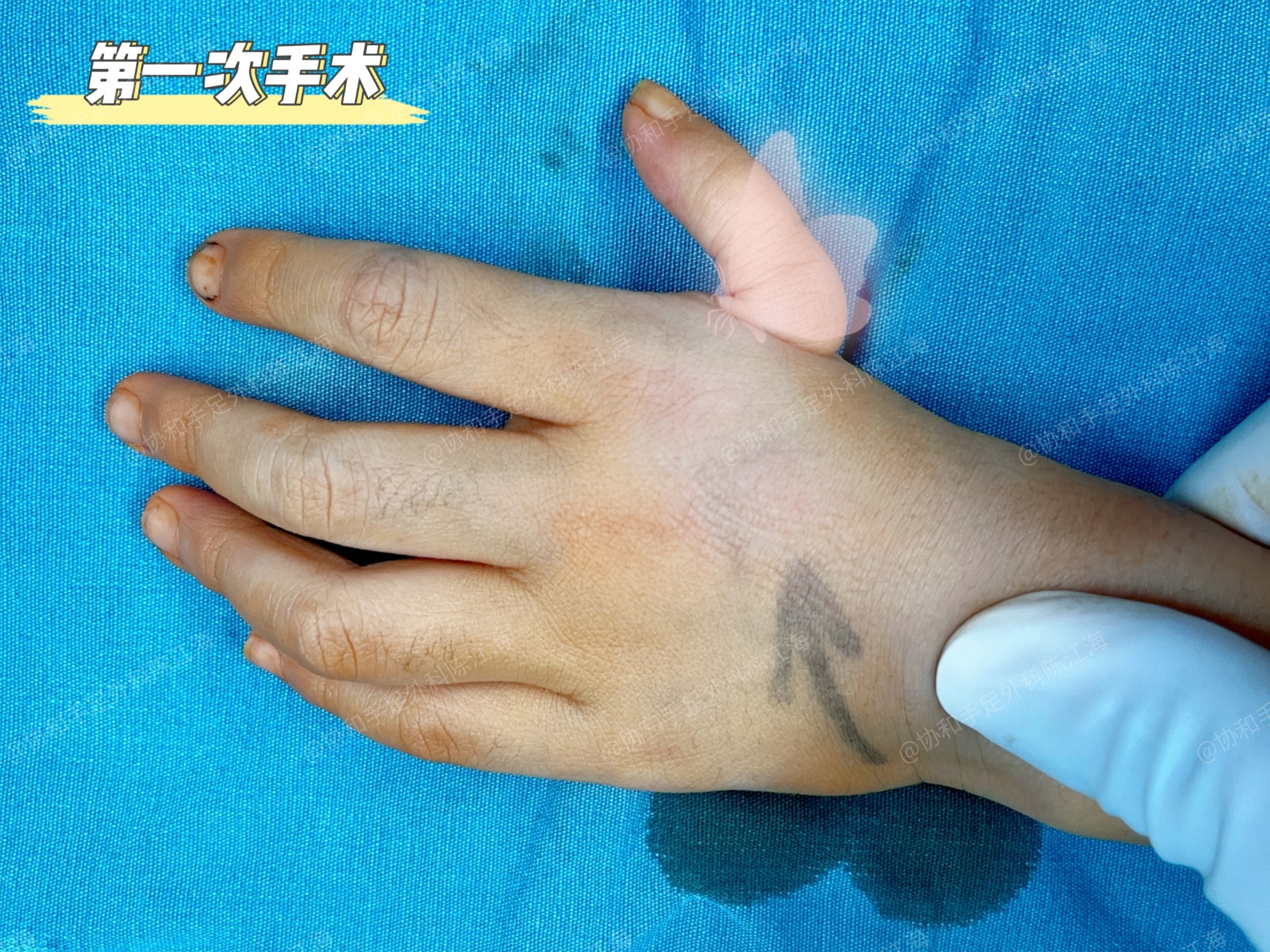 拇女孩的变化令人称赞  这个7岁的小女孩,左手拇指是3c型拇指发育不良