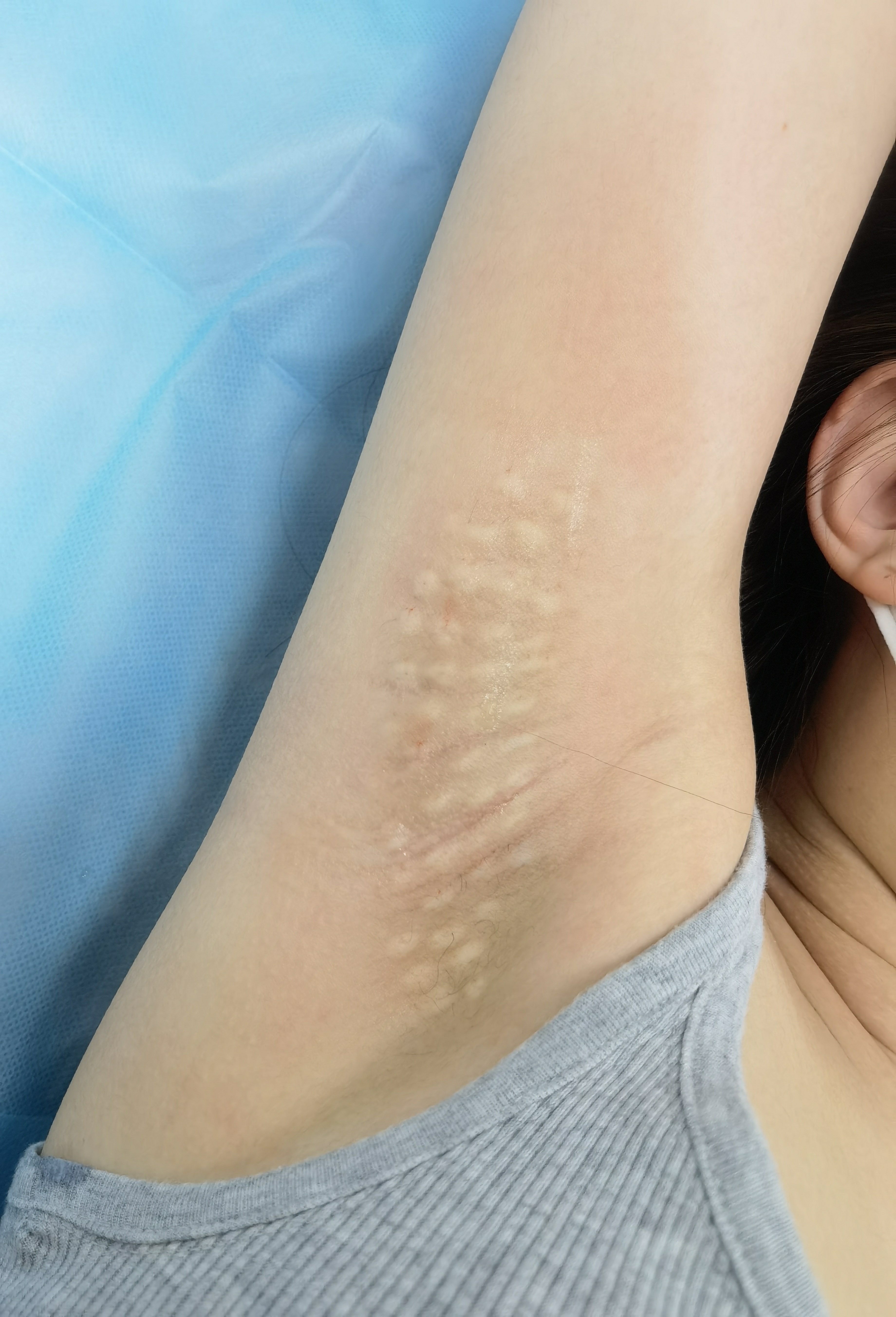 肉毒素治疗腋臭