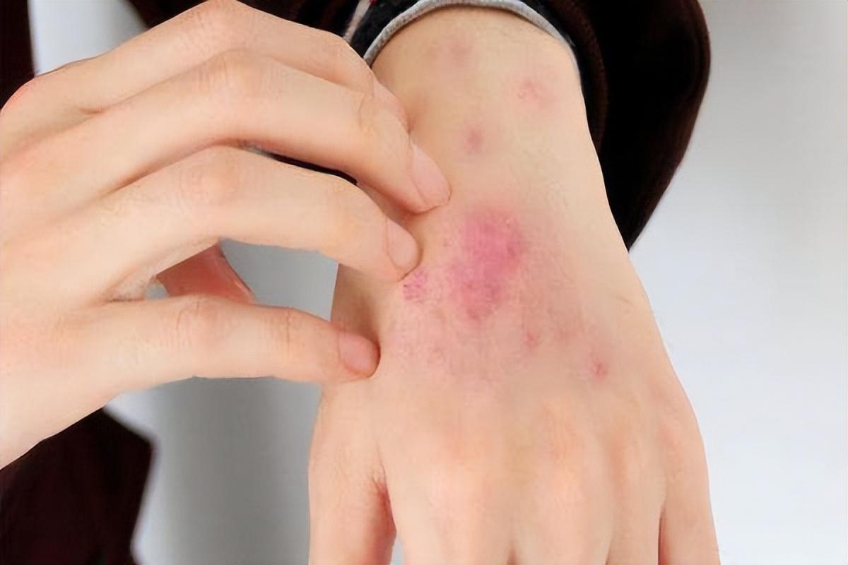 纪实:23岁女学生染上艾滋病,大学生的性,成了艾滋病的温床