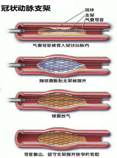 心脏支架球囊图片图片