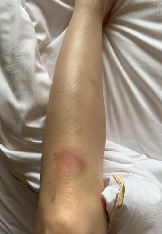 李依晓哭诉拍戏受伤不能自理,膝盖红肿肋骨淤青,眼睛布满血丝