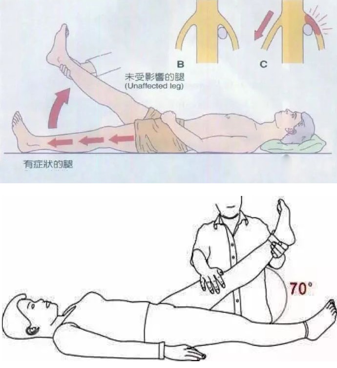 腰腿疼,是不是腰椎间盘突出症引起的?医生教你1个动作测试!