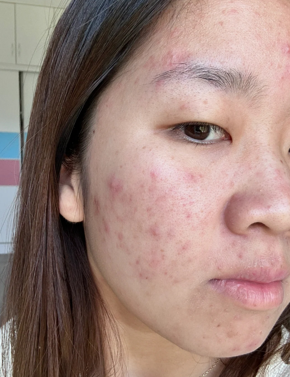 青春痘是青春期常见皮肤问题,影响面部和身体,带来长期身心创伤.