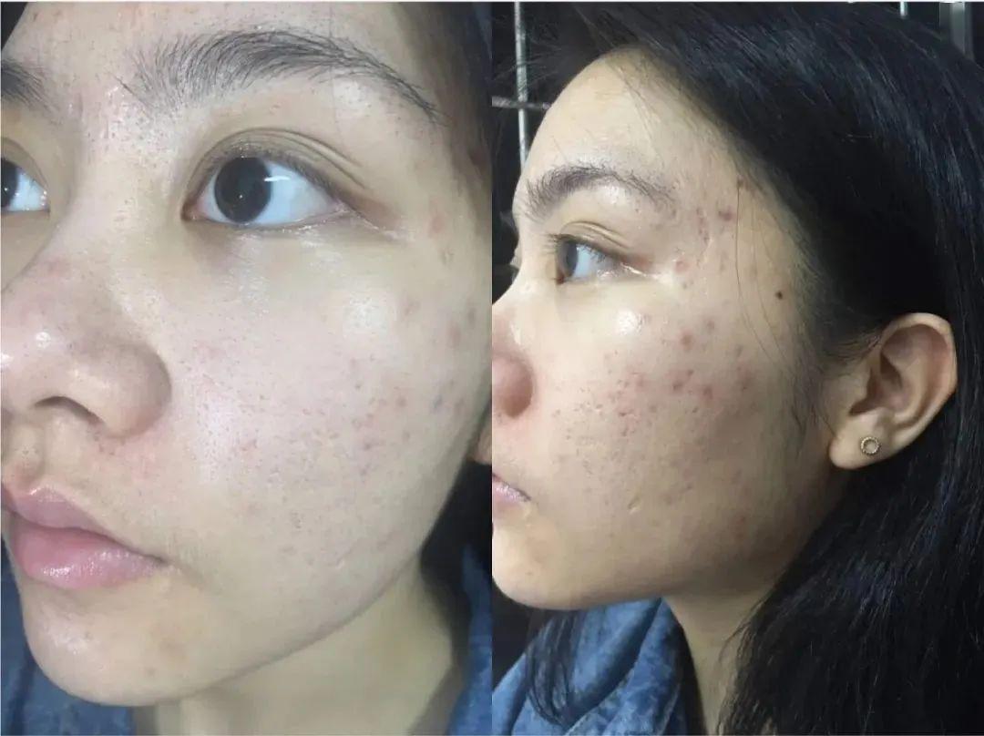 祛痘膏哪个牌子最有效?5年去闭口经验,教你拯救油痘肌!