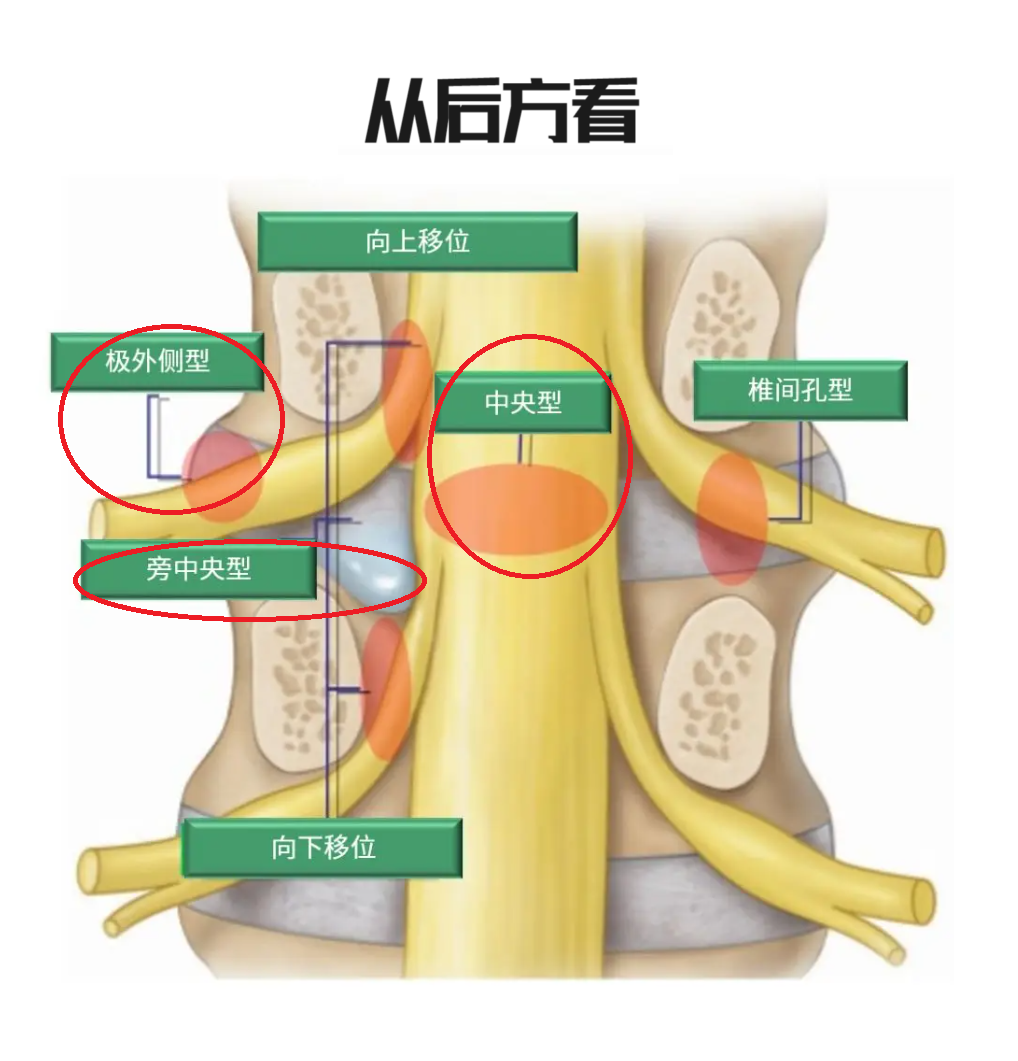 都是得腰椎间盘突出,为啥我的腰腿疼特别严重,别人的却不太疼?