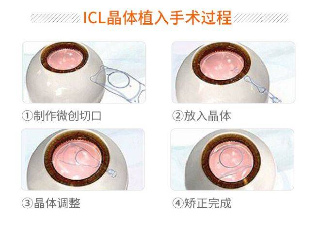 知名演员张新成分享近视眼手术全过程,他选择icl晶体植入