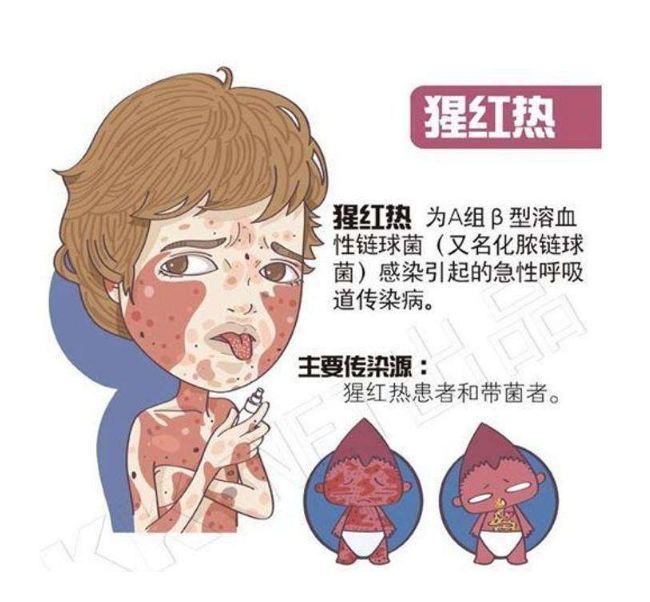 儿科医生说儿童夏季常见疾病之猩红热