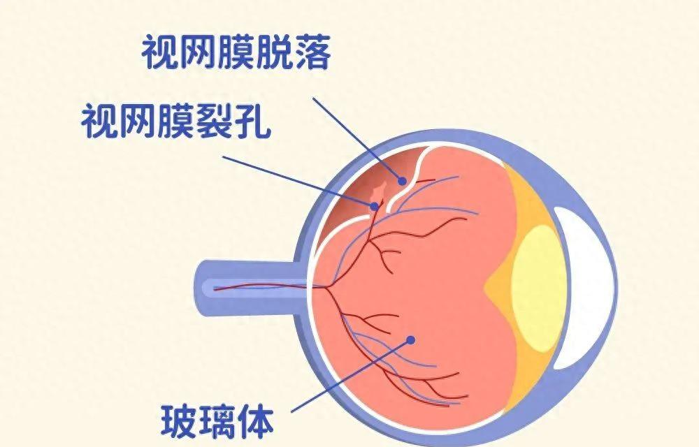 视网膜为什么会脱落