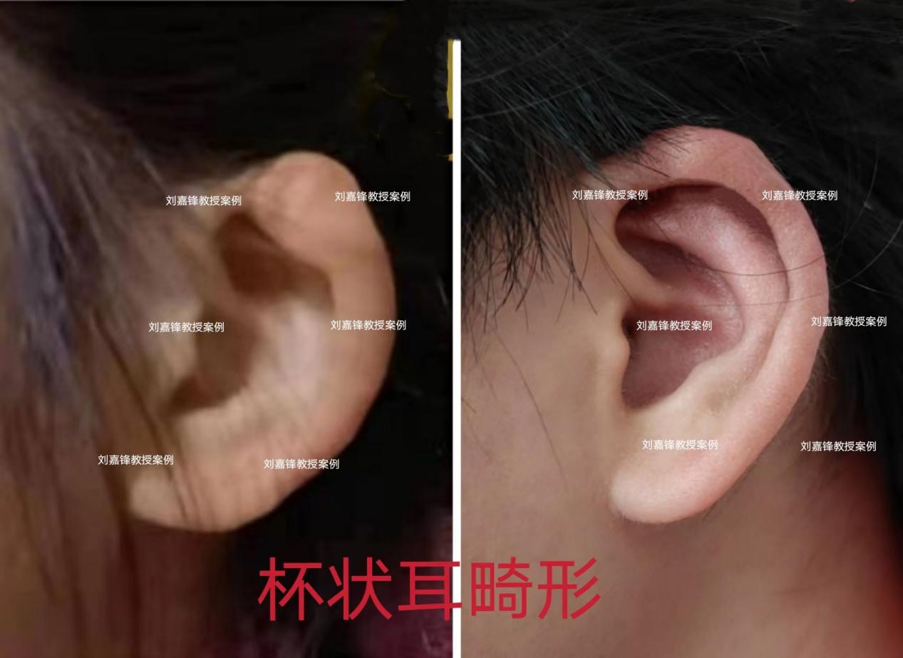 小耳畸形——杯状耳!