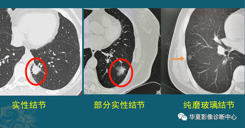 良性肺结节ct图图片