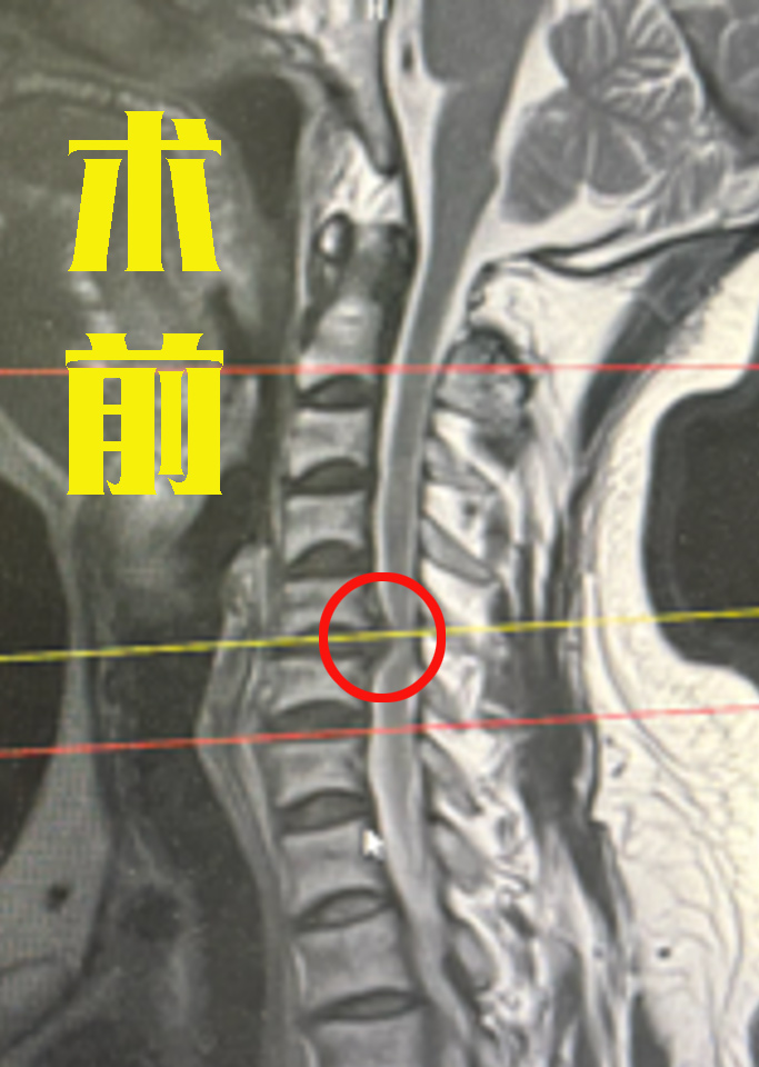 颈椎神经根分布图图片