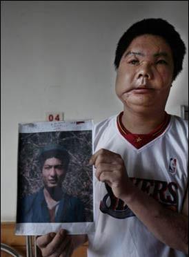 中国换脸第一人李国兴,2006年背60斤西药回家,两年后离奇去世