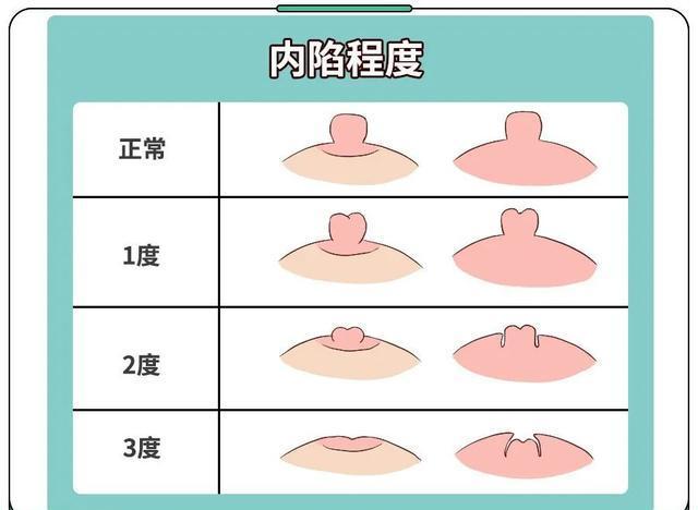 女性乳头炎的症状图片