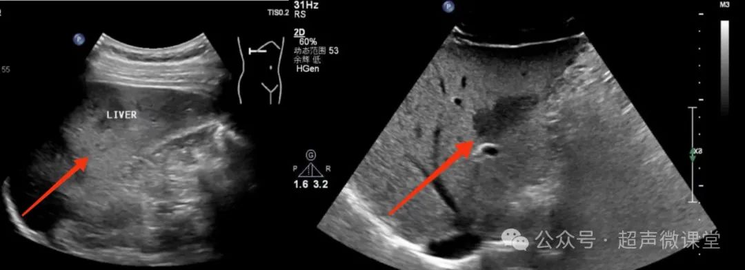 脂肪肝的超声表现