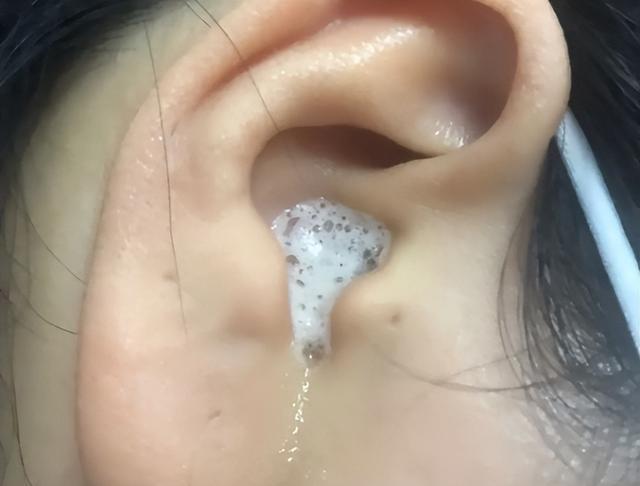 "油耳"和狐臭有关?他是病吗?怎么祛除?