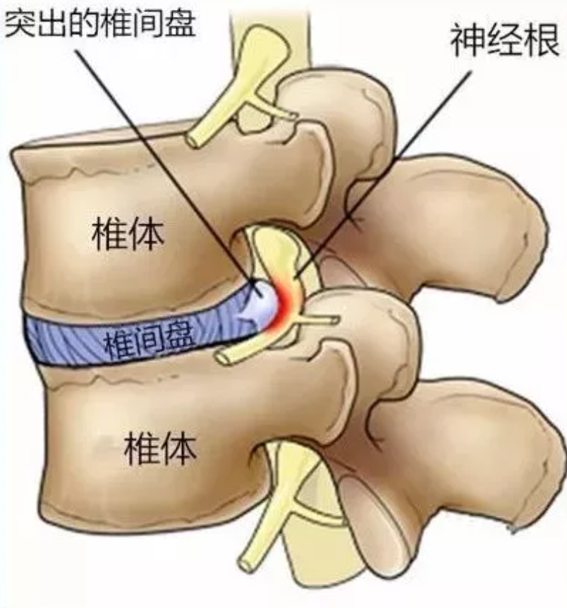 许多得了神经根型颈椎病,腰椎间盘突出症等颈腰椎疾病的患者,最担心的